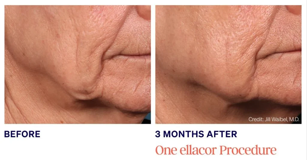 Before and 3 months after ellacor